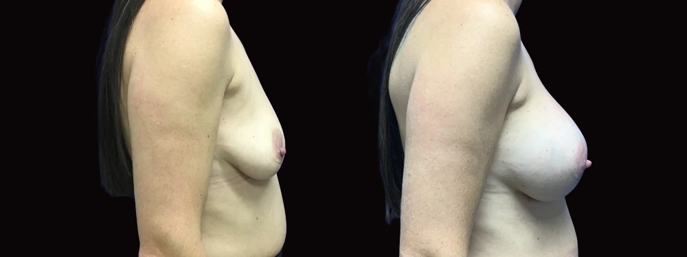 Case 14 before and after right lateral view showing breast augmentation results