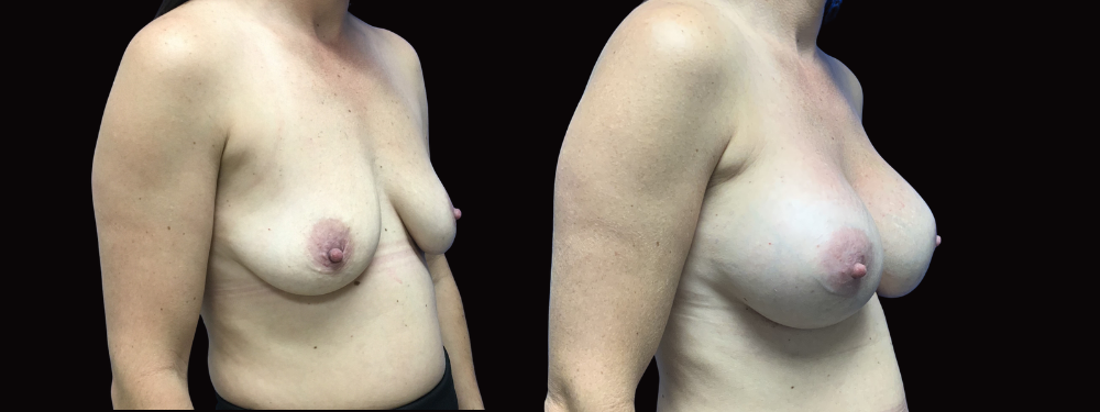 Case 14 before and after right oblique view showing breast augmentation results