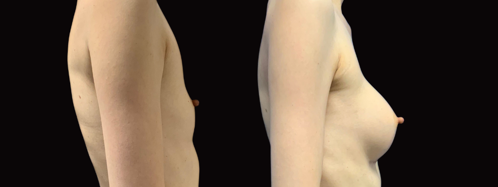 Before and after breast augmentation surgery, right lateral view