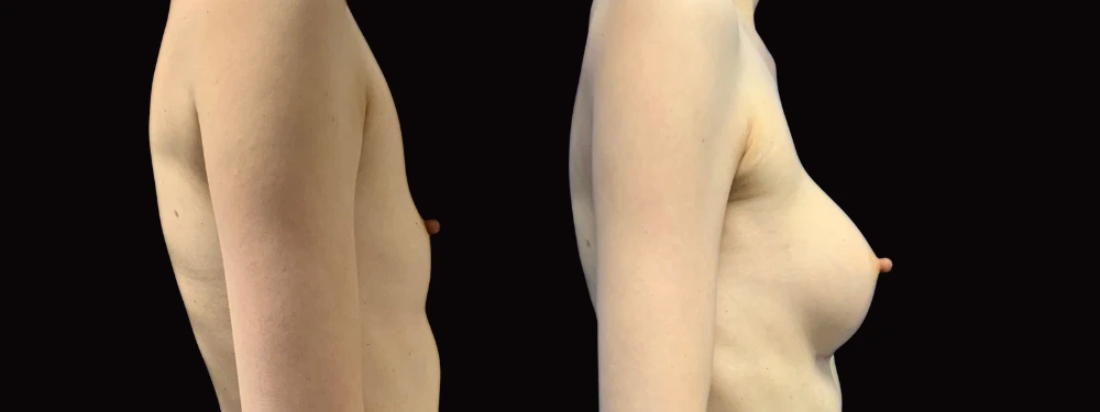 Before and after breast augmentation surgery, right lateral view