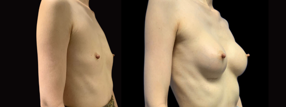 Before and after breast augmentation surgery, right oblique view
