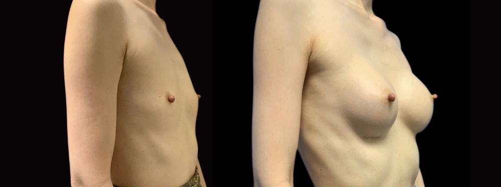Before and after breast augmentation surgery, right oblique view