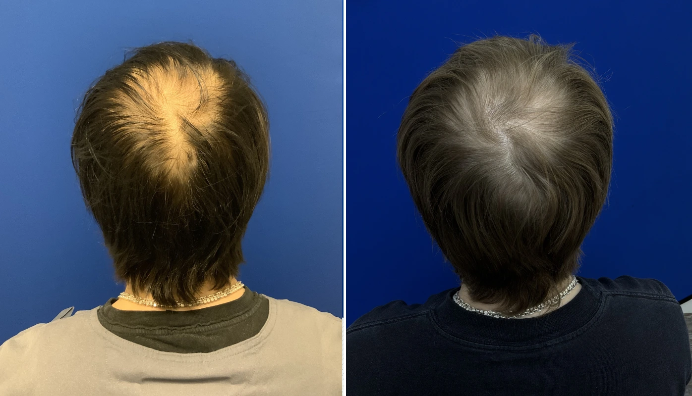 Before and after comparison of scalp hair coverage from overhead view