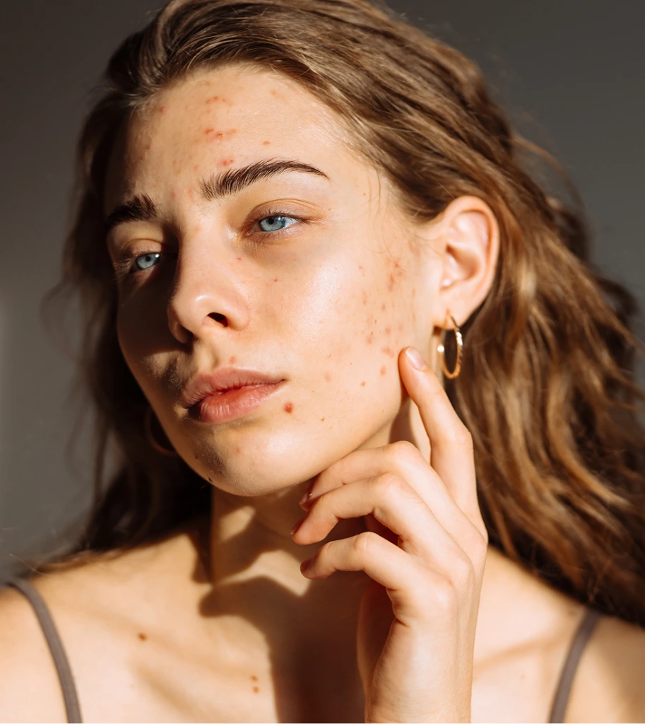 Person with visible acne scars on forehead and cheek, touching face