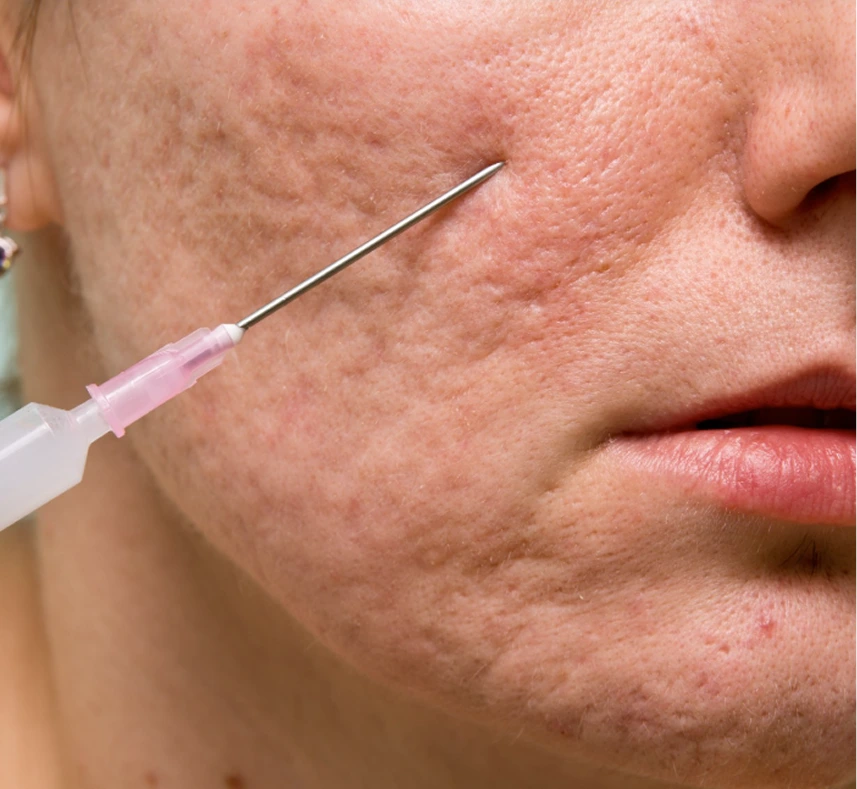 Injectable needle administering dermal filler into cheek to treat acne scars