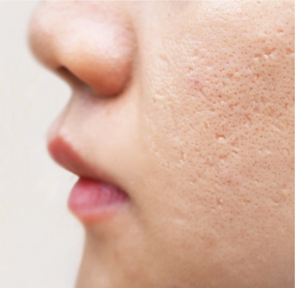 Close-up side profile of facial skin texture showing pores and complexion