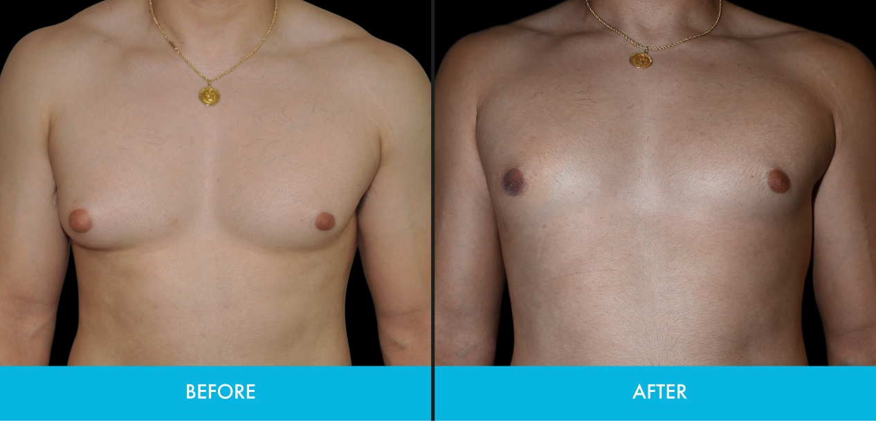 Before and after gynecomastia surgery results showing chest contouring