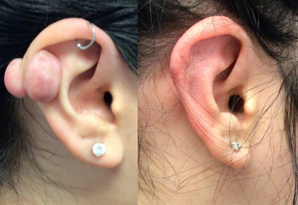 Before and after ear surgery showing right ear correction, left side with prominence and right side with refined contour