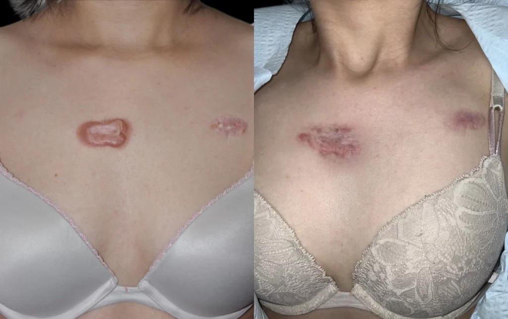 Before and after scar revision on chest, showing reduced scar visibility and improved appearance
