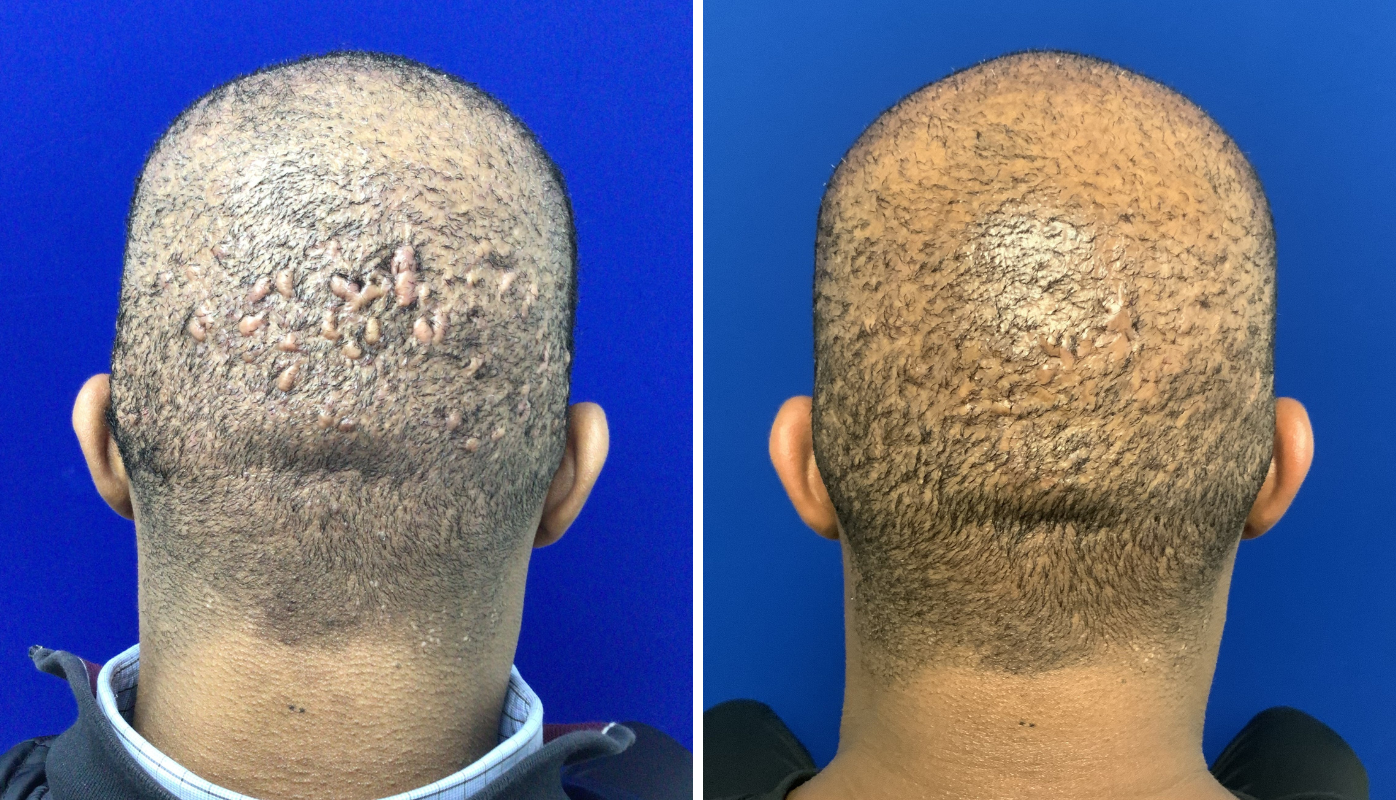 Before and after rear view of scalp showing hair restoration results against blue background