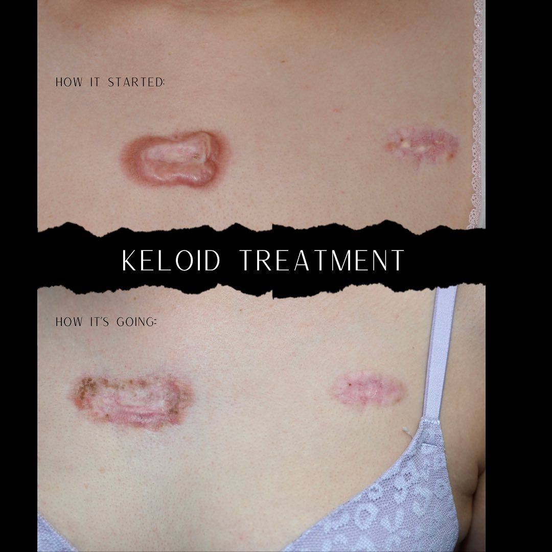 Before and during keloid treatment on the chest at Premier Plastic Surgery in Pearland, TX