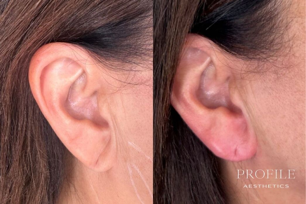 Dermal Fillers (18)