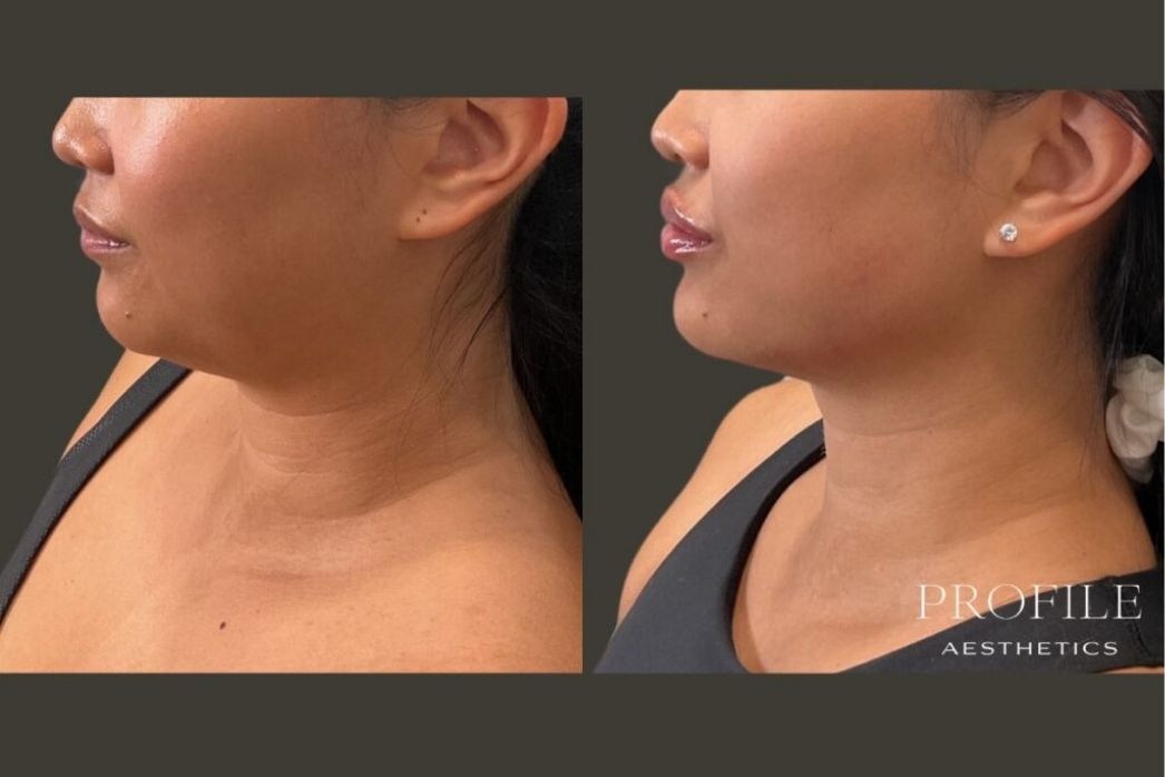 Dermal Fillers (24)