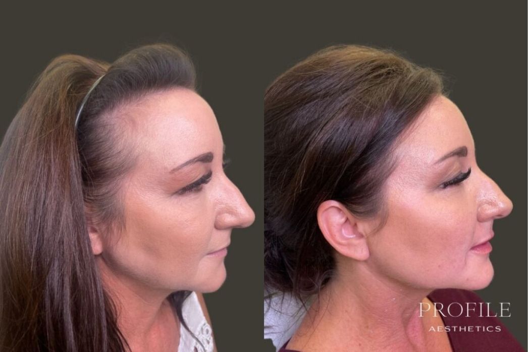 Dermal Fillers (5)