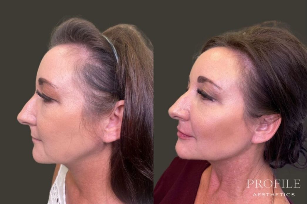 Dermal Fillers (7)