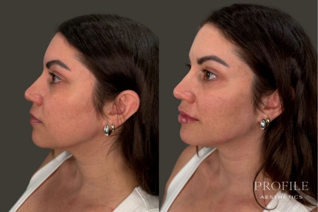 Dermal Fillers (9)