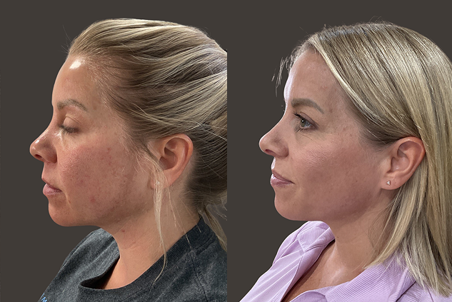 Microneedling new cases - images (2)