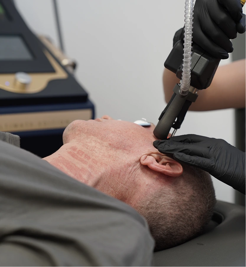 Provider performing RF microneedling treatment on patient's cheek and jawline