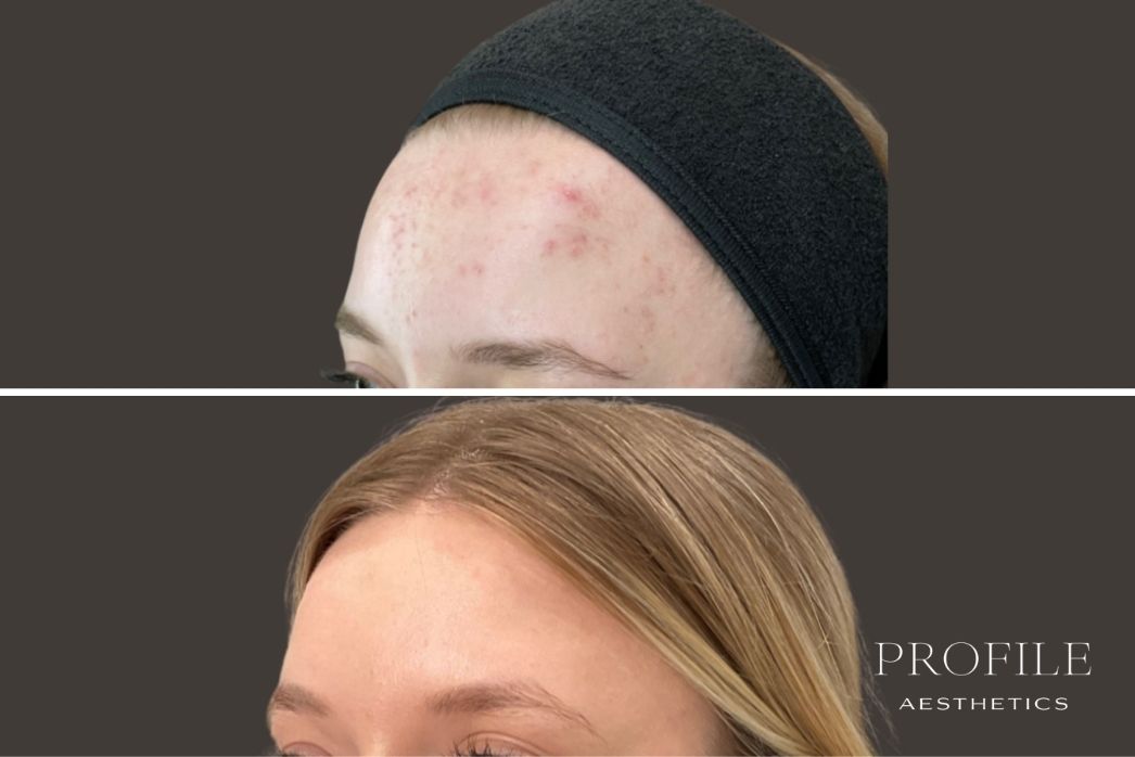 Microneedling (2)