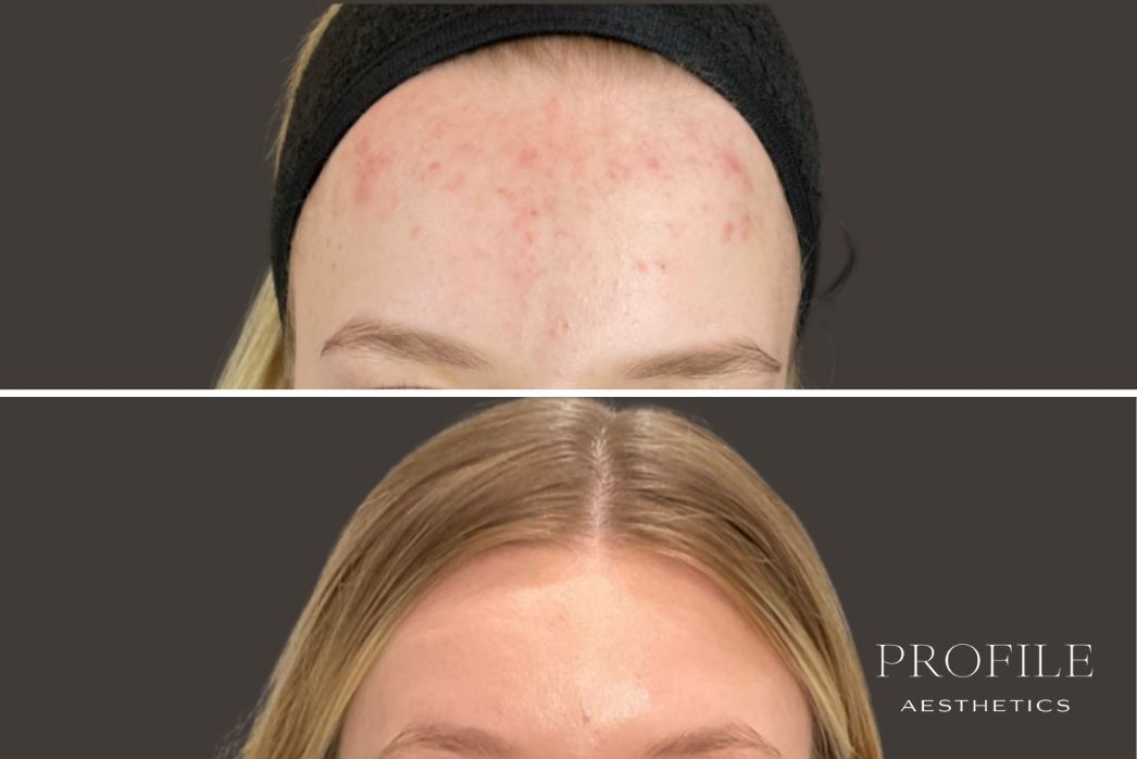 Microneedling
