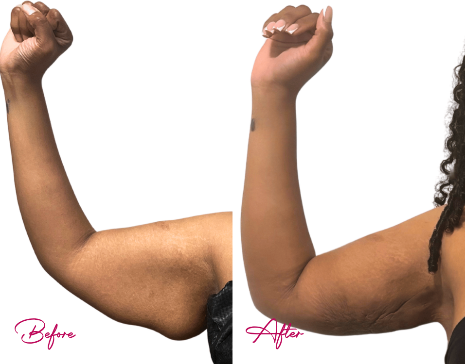 Arm Lipo - Case 5