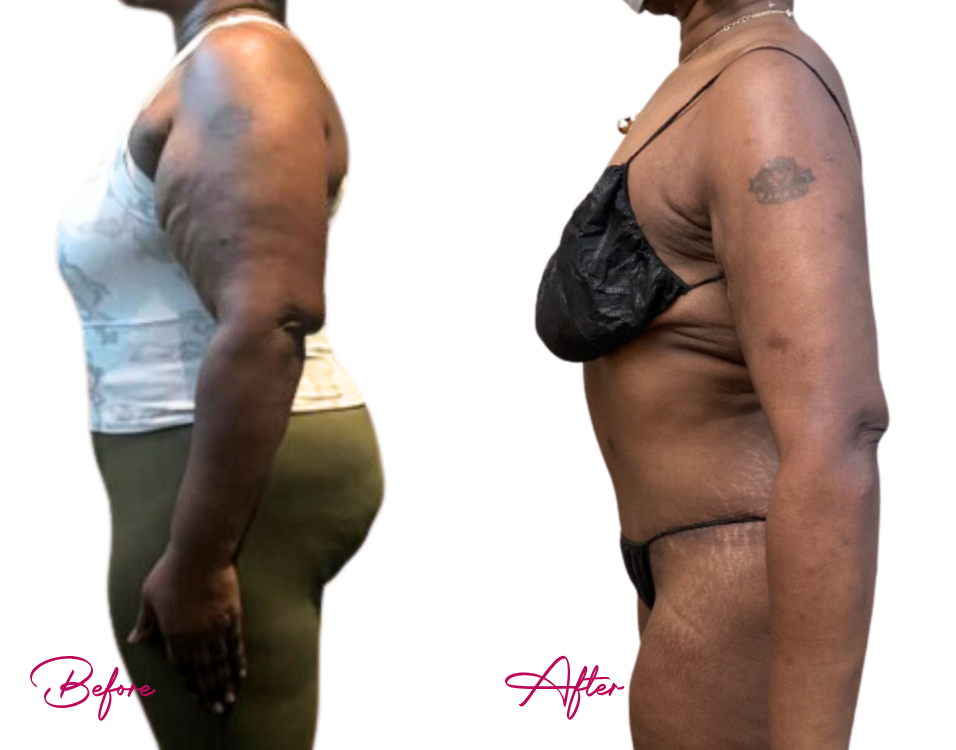 Arm Lipo - Case 5