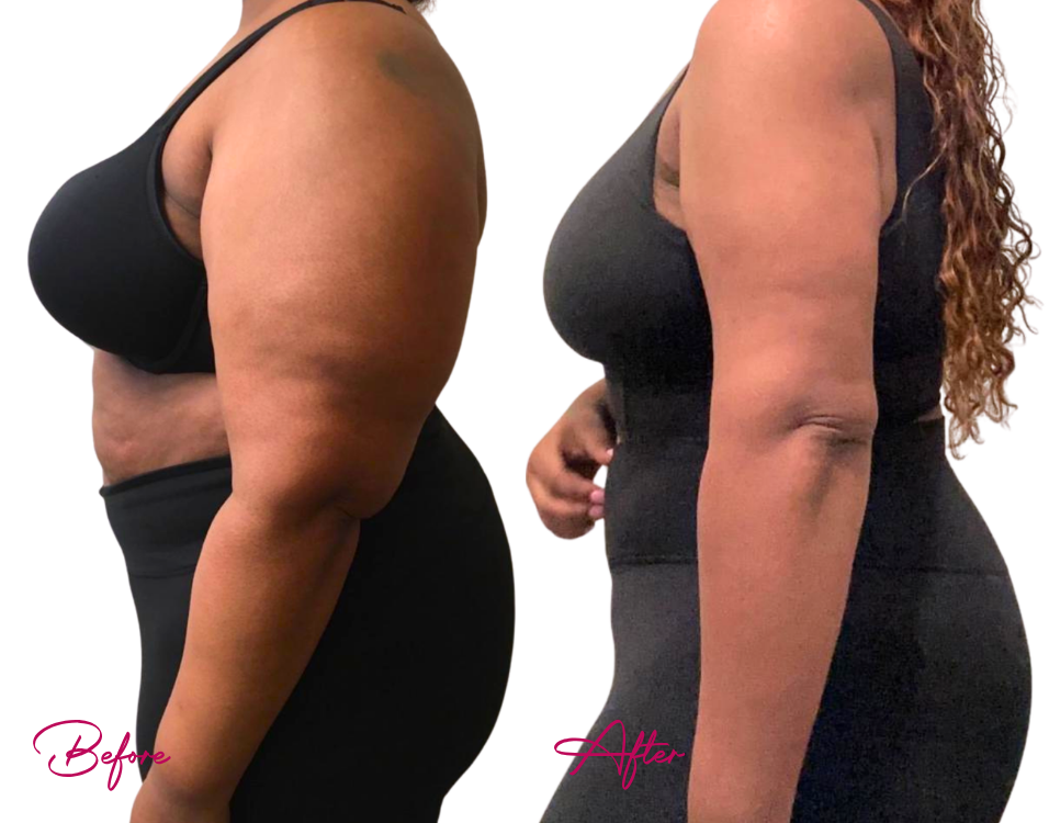 Arm Lipo - Case 6