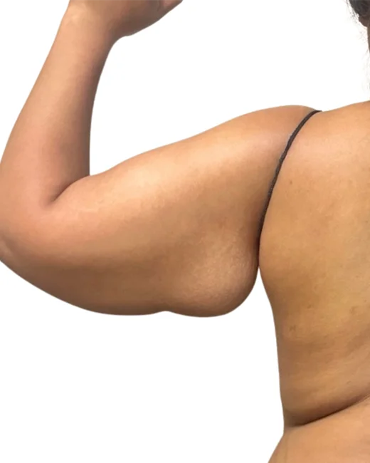 Awake Arm Lift Case 14577 Before