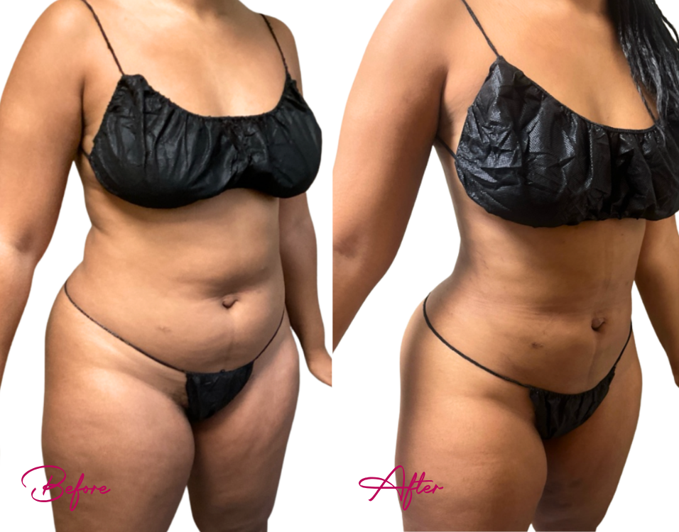 AWAKE Lipo- Case 18