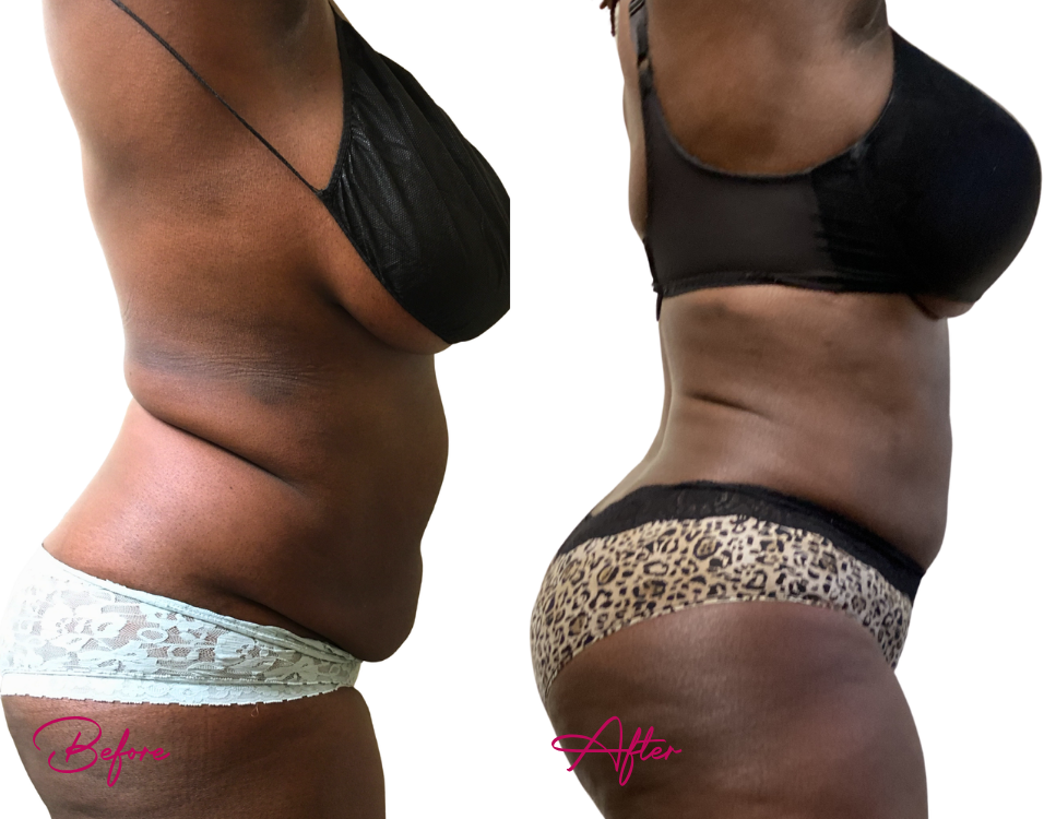 AWAKE Lipo- Case 19