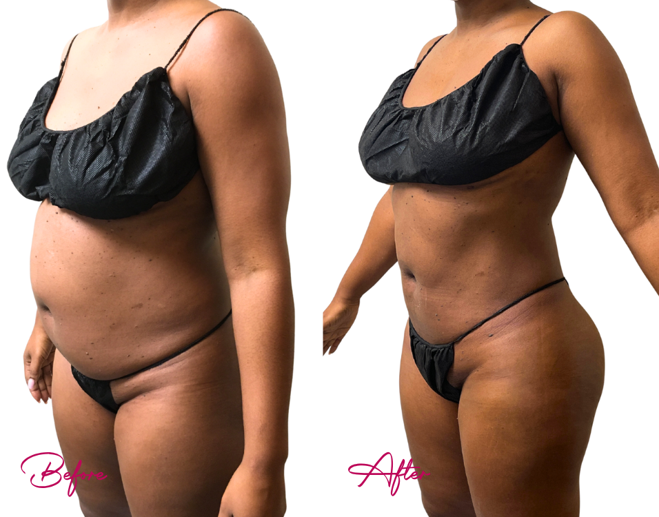 AWAKE Lipo- Case 20