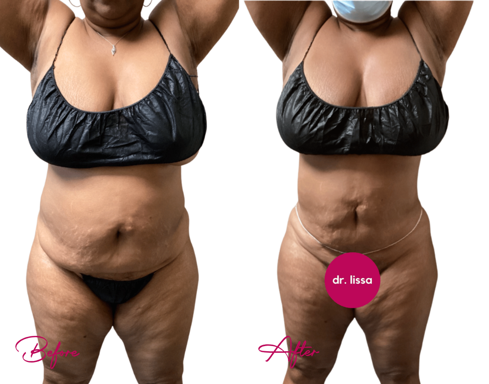 AWAKE Lipo- Case 21