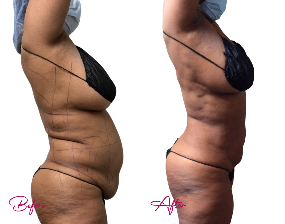AWAKE Lipo- Case 22