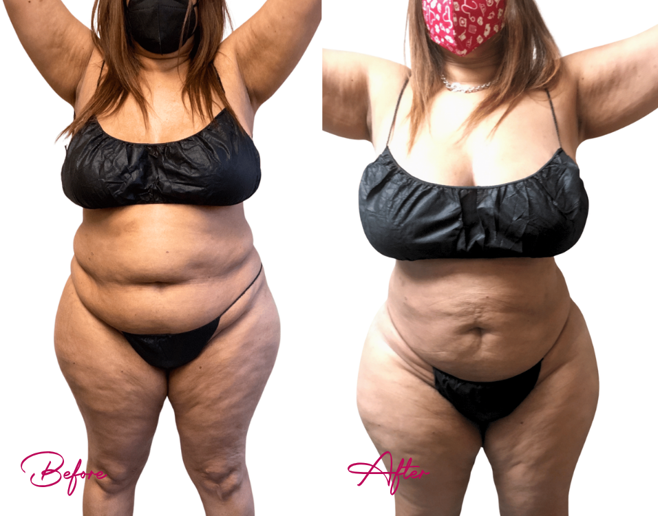 AWAKE Lipo- Case 23