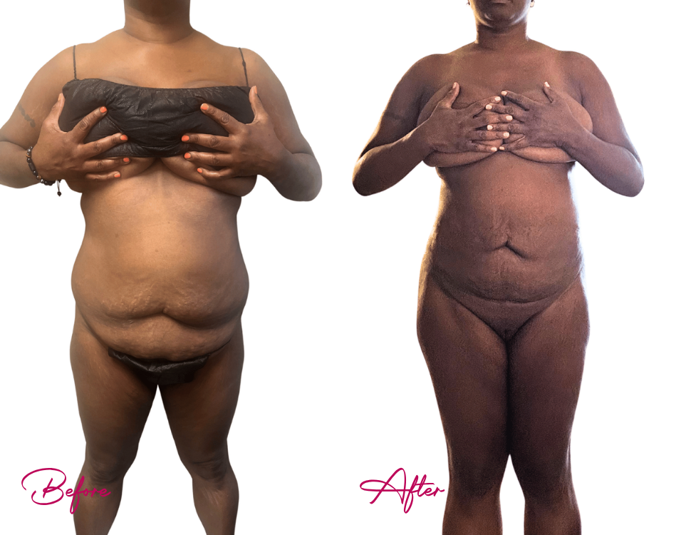 AWAKE Lipo- Case 24