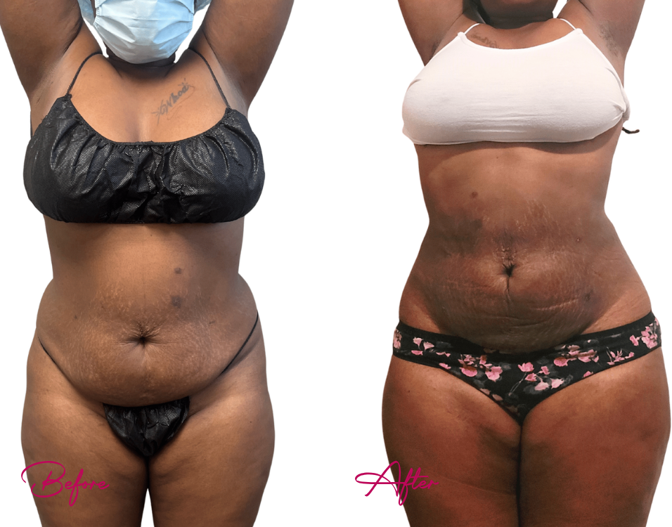 AWAKE Lipo- Case 25