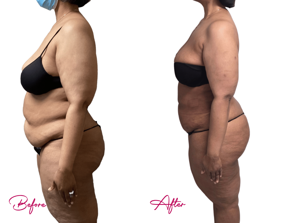 AWAKE Lipo- Case 27