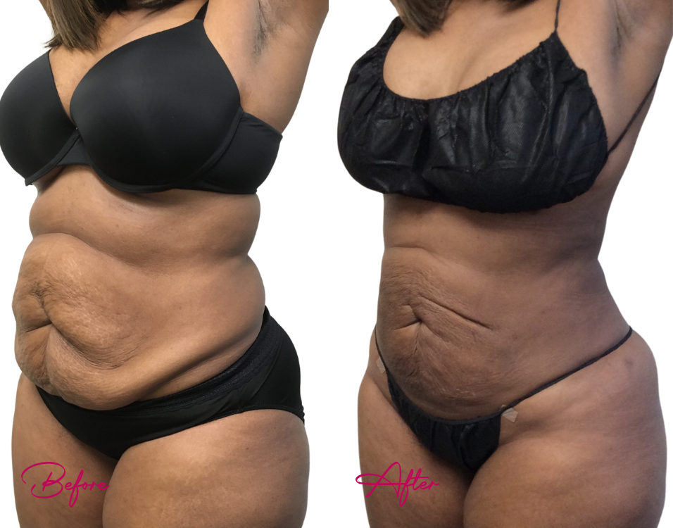 AWAKE Lipo- Case 28