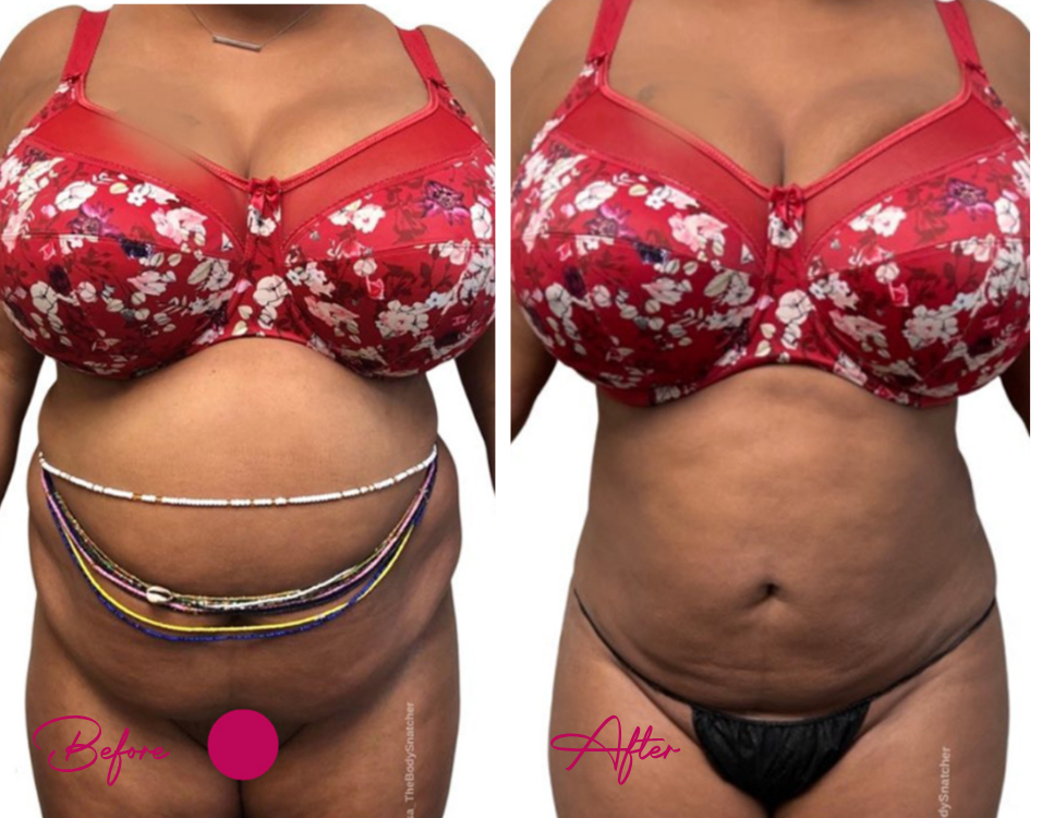 AWAKE Lipo- Case 33