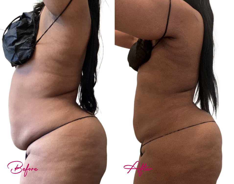 AWAKE Lipo- Case 34