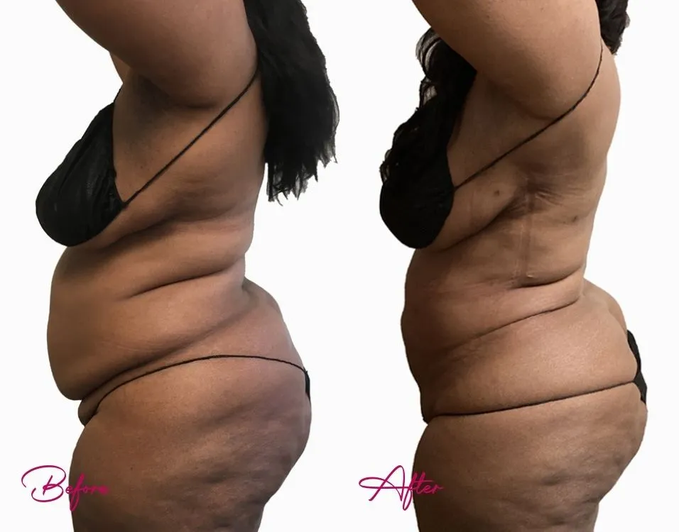 Awake Liposuction - Case 3.1