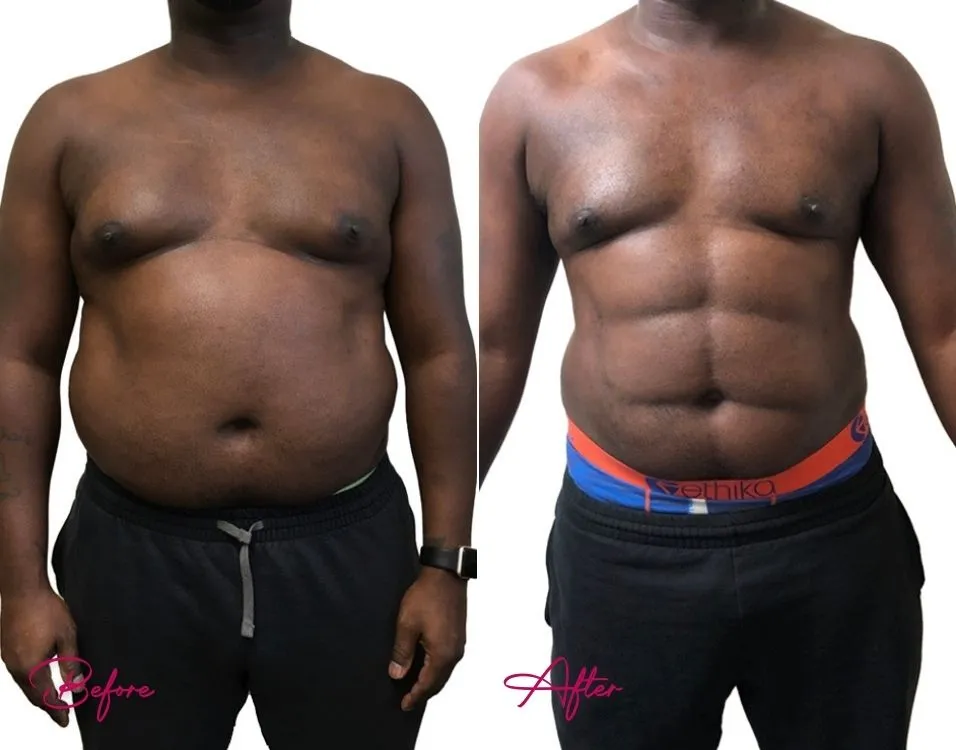 Awake Liposuction (MALE) - Case 1.1