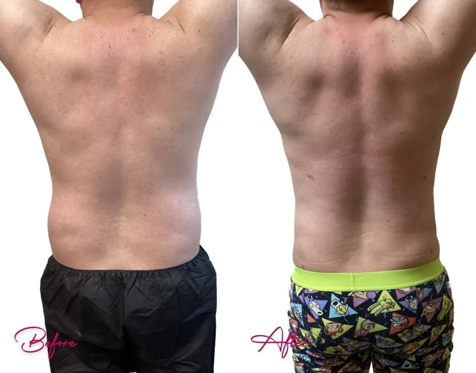 Awake Liposuction (MALE) - Case 2.1