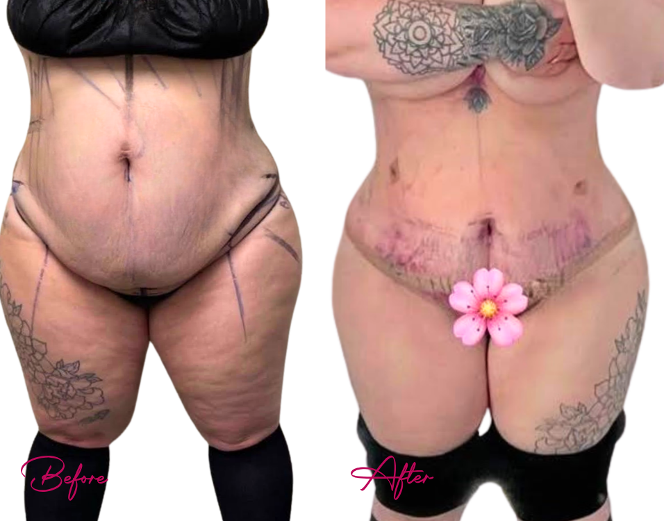 awake TUMMY - Case 2