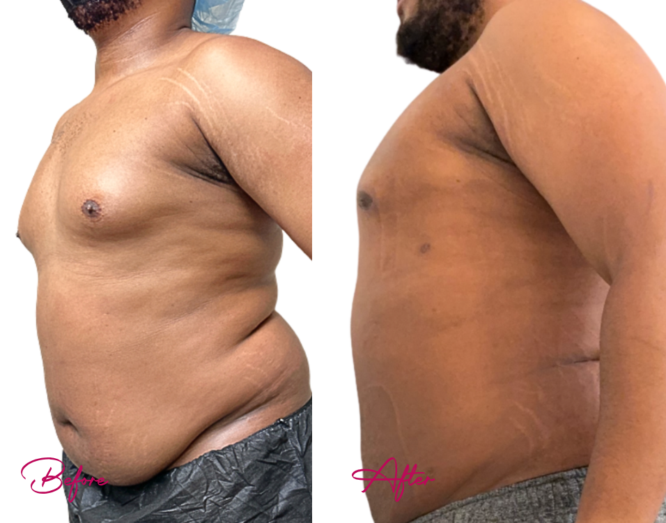 Gyno Case 9