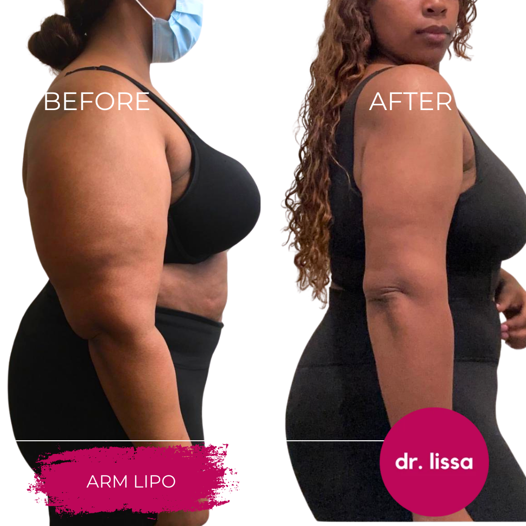 High-BMI-Case1-Arm Lipo(1)