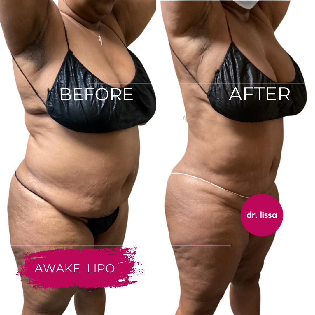 High-BMI-Case12-awake lipo(3)