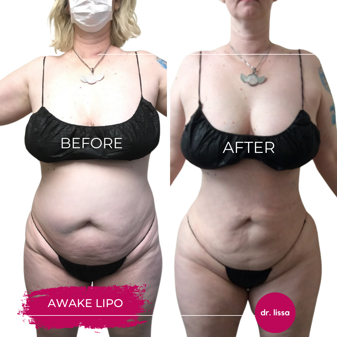 High-BMI-Case14-Awake Lipo(1)