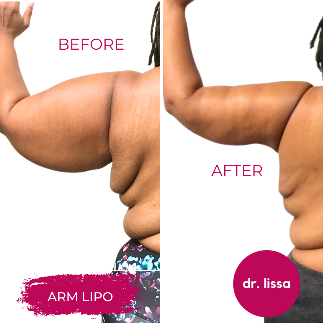 High-BMI-Case2-Arm Lipo(2)
