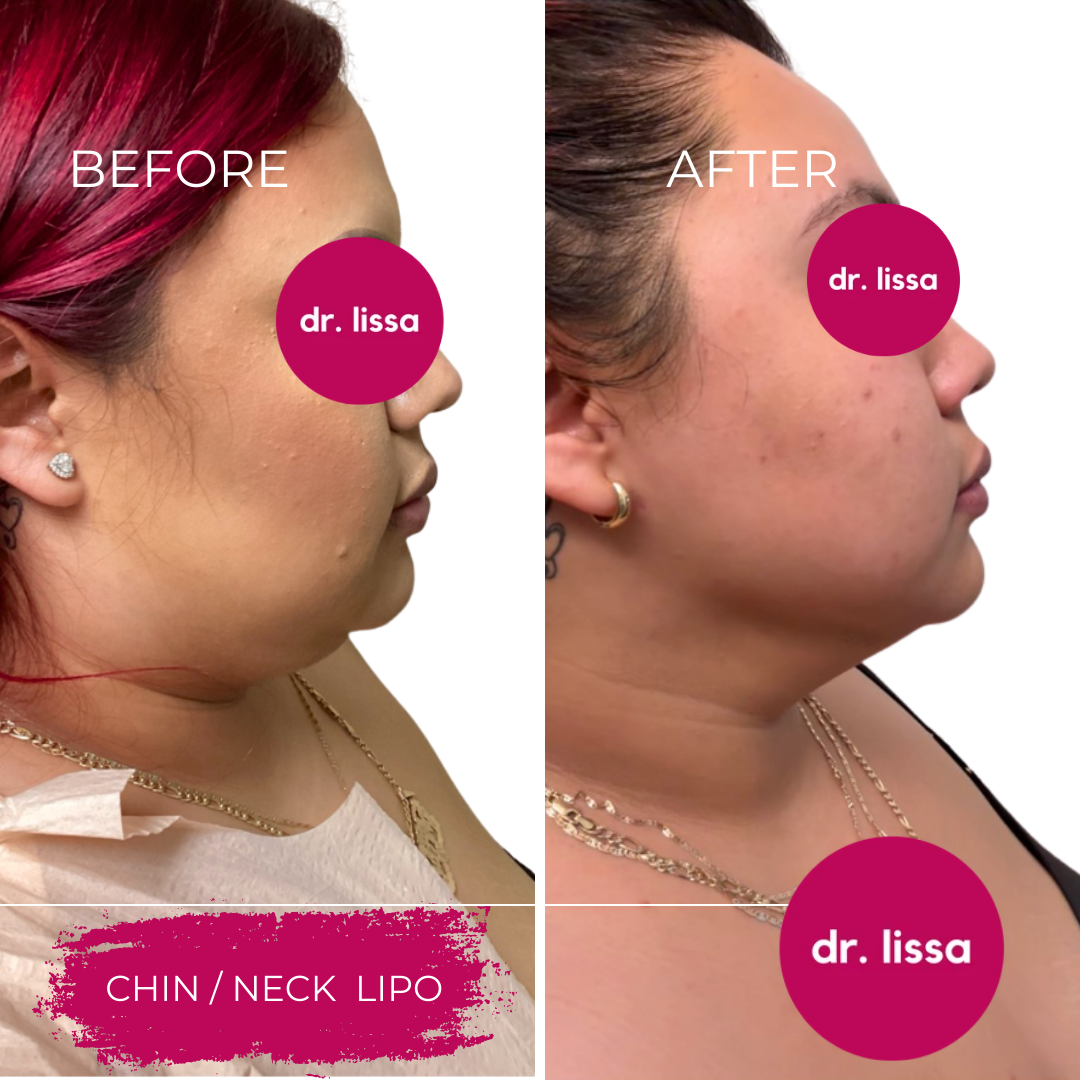 High-BMI-Case3-Chin Lipo